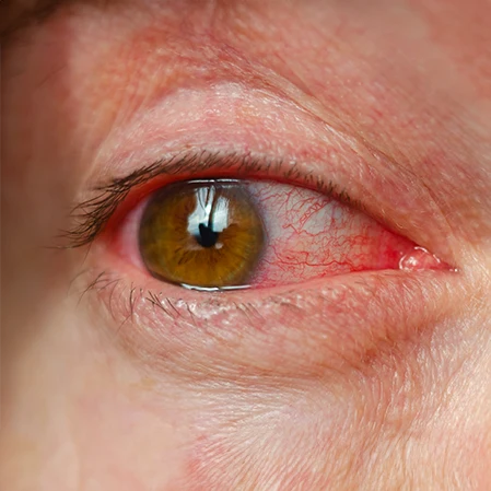 A patient with pink eye